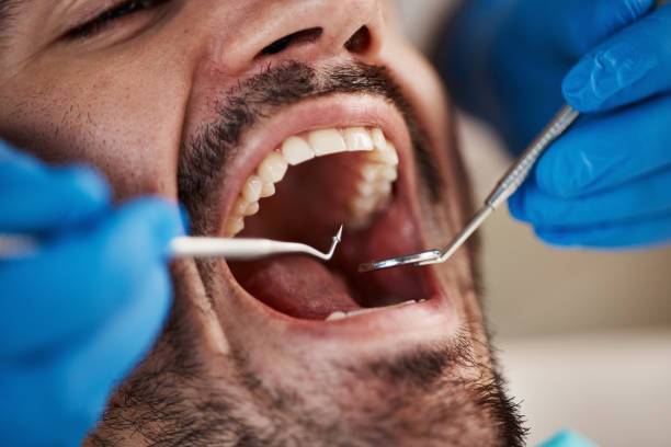Best Emergency Treatment for Dental Infections or Abscesses in Deerfield Beach, FL